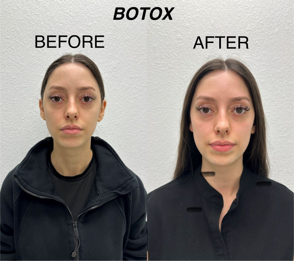 botox01